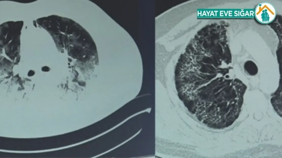 Koronavirüs akciğerinin yüzde 80'ini kaplamıştı ozon tedavisiyle hayata döndü